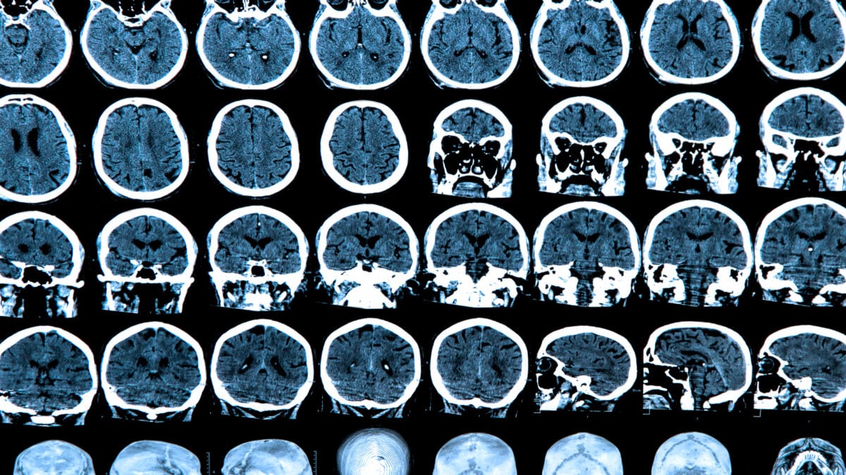 نجاح العلاج الجيني في إبطاء داء هنتنغتون بنسبة 75٪ خلال تجربة سريرية هامة عام 2025