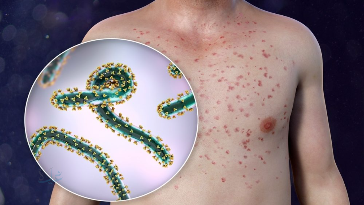 تفشٍ مقلق في غرب إفريقيا.. 404 إصابات و42 وفاة نتيجة الحمى النزفية في موريتانيا والسنغال