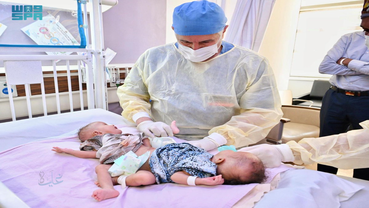 بعد 12 ساعة من الجراحة.. نجاح فصل التوأم الملتصق رحمة ورملا في الرياض